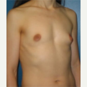 32 year old breast augmentation with high profile silicone gel implants 1747954