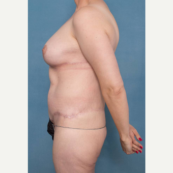 35-44 year old woman treated with Body Lift after 3450544