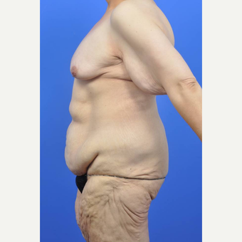35-44 year old woman treated with Body Lift before 3450544