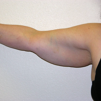 51 year old woman treated with Liposuction before 3684708