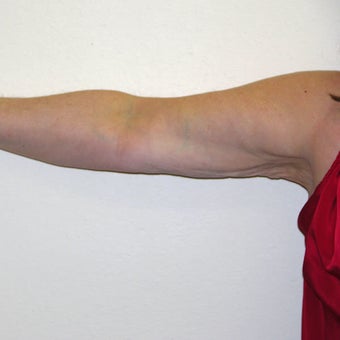 51 year old woman treated with Liposuction after 3684708