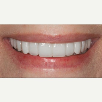 65-74 year old woman treated with Porcelain Veneers after 2370024