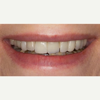 65-74 year old woman treated with Porcelain Veneers before 2370024