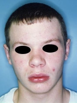 17 year old male patient after 917887