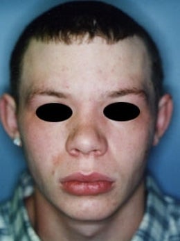17 year old male patient before 917887