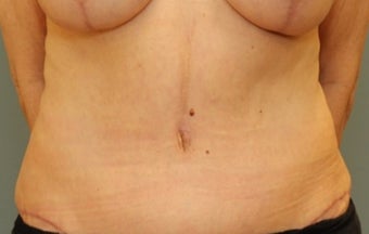 55-64 year old woman requesting Tummy Tuck after 3031493