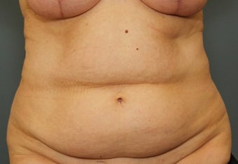 55-64 year old woman requesting Tummy Tuck before 3031493