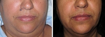 Mole Removal photos before 951874