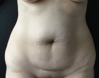 Belly Button Surgery before 1192800