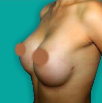 25-34 year old woman treated with Breast Augmentation after 3242040