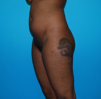 18-24 year old woman treated with Smart Lipo before 3452635