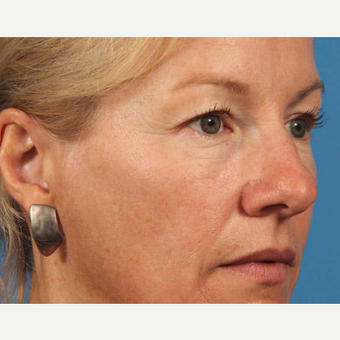 45-54 year old woman treated with Eye Bags Treatment before 3787613