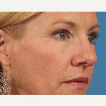 45-54 year old woman treated with Eye Bags Treatment after 3787613