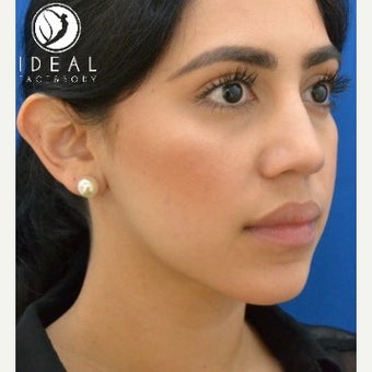 24 year old woman after laser sculpting liposuction of the chin, neck, and buccal fat removal. after 1910413