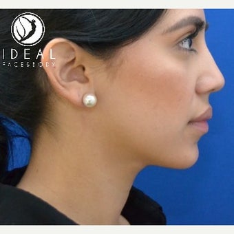 24 year old woman after laser sculpting liposuction of the chin, neck, and buccal fat removal. 1910413