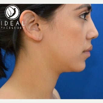 24 year old woman after laser sculpting liposuction of the chin, neck, and buccal fat removal. 1910413