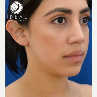 24 year old woman after laser sculpting liposuction of the chin, neck, and buccal fat removal. before 1910413
