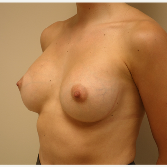 25-34 year old woman treated with Breast Augmentation after 3037825