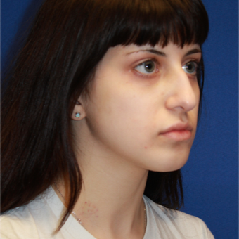 21 year old woman treated with Fat Transfer before 3023733