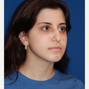 21 year old woman treated with Fat Transfer after 3023733