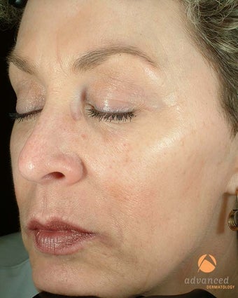 Patient Treated with BOTOX® Cosmetic & Restylane® after 1047011