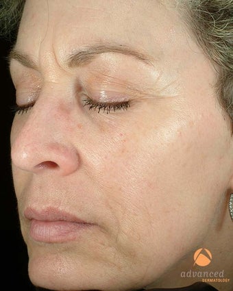 Patient Treated with BOTOX® Cosmetic & Restylane® before 1047011
