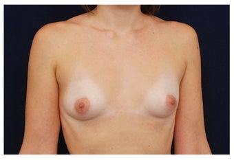 Breast Augmentation before 1230013