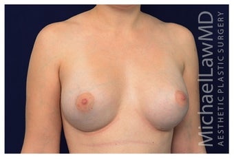 Breast Augmentation after 1230013