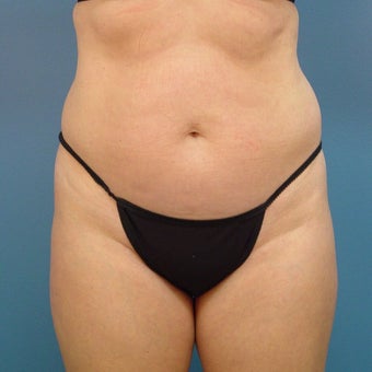 35-44 year old woman treated with Tummy Tuck before 1980344