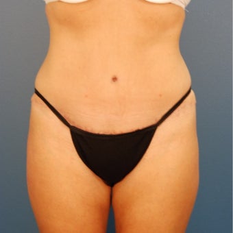 35-44 year old woman treated with Tummy Tuck after 1980344