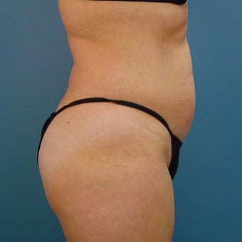 35-44 year old woman treated with Tummy Tuck 1980344
