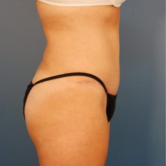 35-44 year old woman treated with Tummy Tuck 1980344