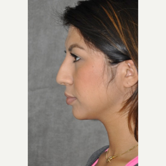 18-24 year old woman treated with Rhinoplasty before 3181406