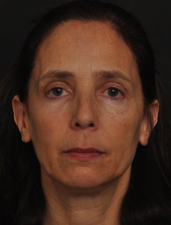 Non-surgical upper eyelid rejuvenation after 1402204