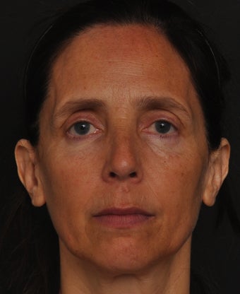 Non-surgical upper eyelid rejuvenation before 1402204