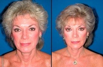 61 year old woman treated with Facelift before 3004822