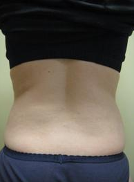 Smart Lipo after 1027802