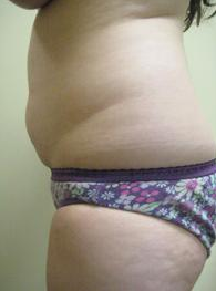 Smart Lipo 1027802
