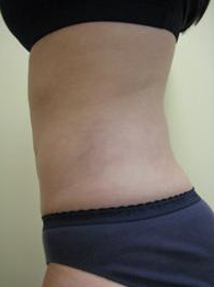 Smart Lipo 1027802