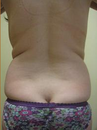 Smart Lipo before 1027802