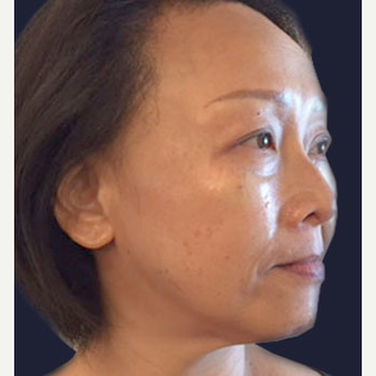 45-54 year old woman treated with Injectable Fillers after 3243246