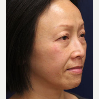 45-54 year old woman treated with Injectable Fillers before 3243246
