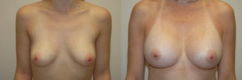 Breast Augmentation with Implants before 1271886