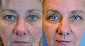 Eyelid Surgery before 974125