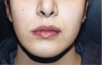 18-24 year old woman treated with Lip Implants after 1544034