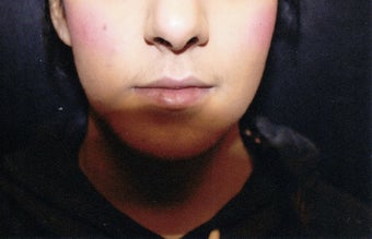 18-24 year old woman treated with Lip Implants before 1544034