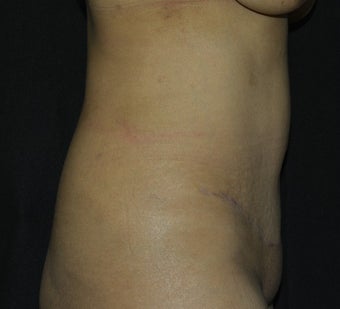 35-44 year old woman treated with Tummy Tuck after 2189770