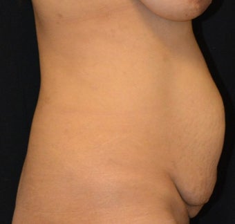 35-44 year old woman treated with Tummy Tuck before 2189770