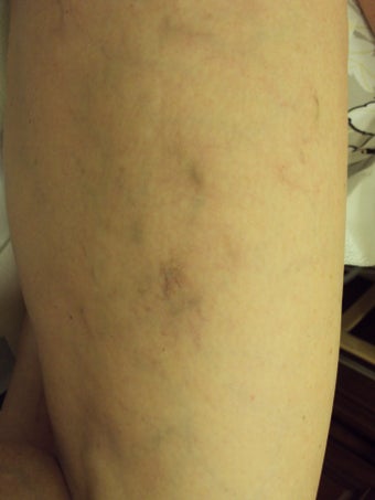 Sclerotherapy 1046955