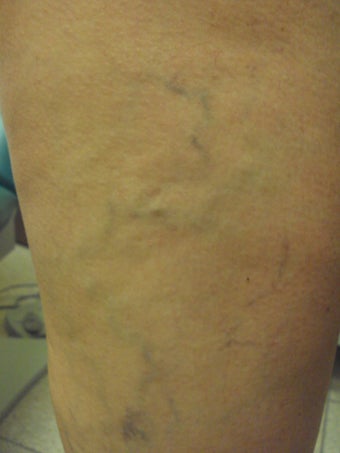 Sclerotherapy 1046955